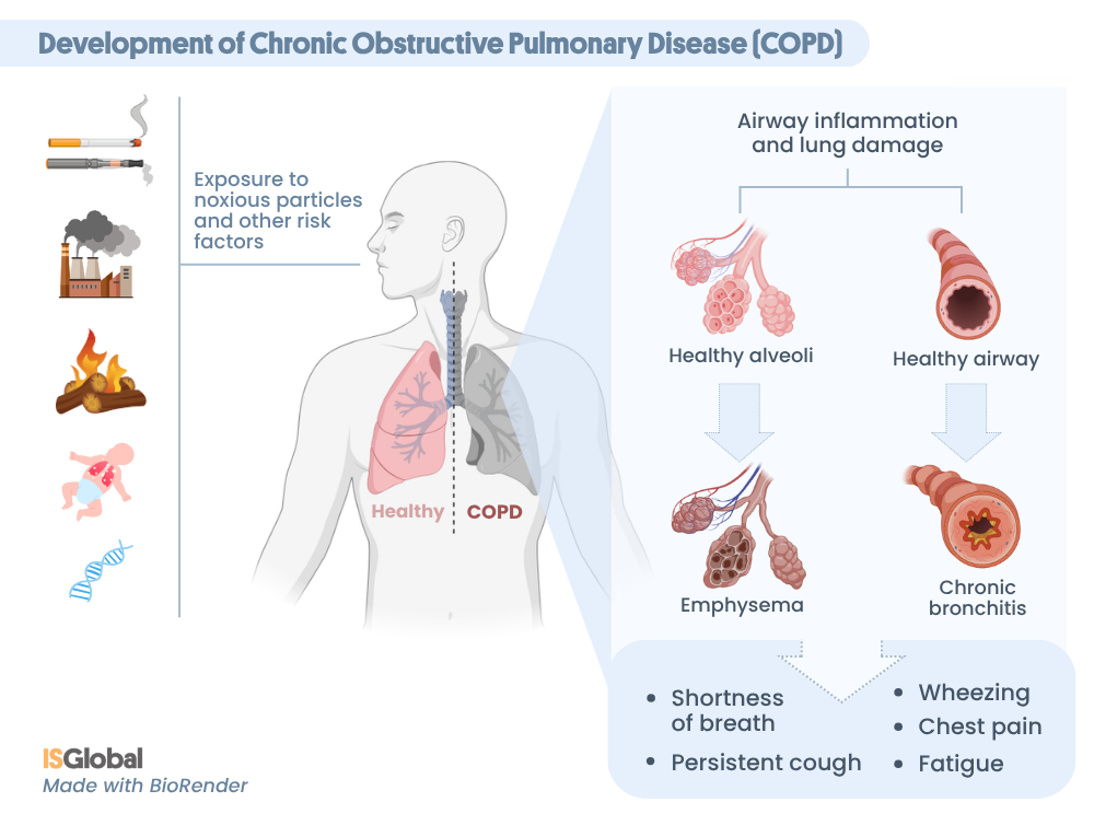 The development of COPD. An infographic showing the risk factors (smoking, pollution and exposure to toxins, second-hand smoke, childhood respiratory infections and genetic abnormalities), and a comparison between healthy alveoli and airways (healthy lung) and emphysema and chronic bronchitis (COPD).
