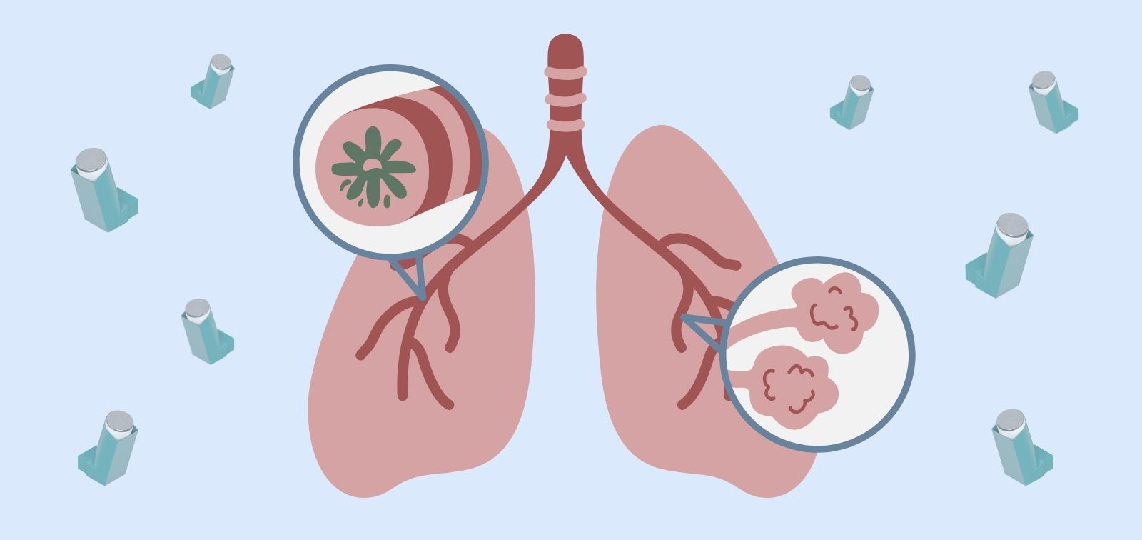 Iconos que representan la EPOC; en el centro, unos pulmones con bronquitis crónica y enfisema. Alrededor, inhaladores.